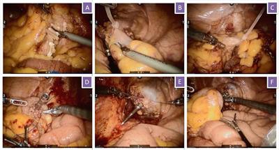 Safety and Feasibility of Robotic Natural Orifice Specimen Extraction Surgery in Colorectal Neoplasms During the Initial Learning Curve